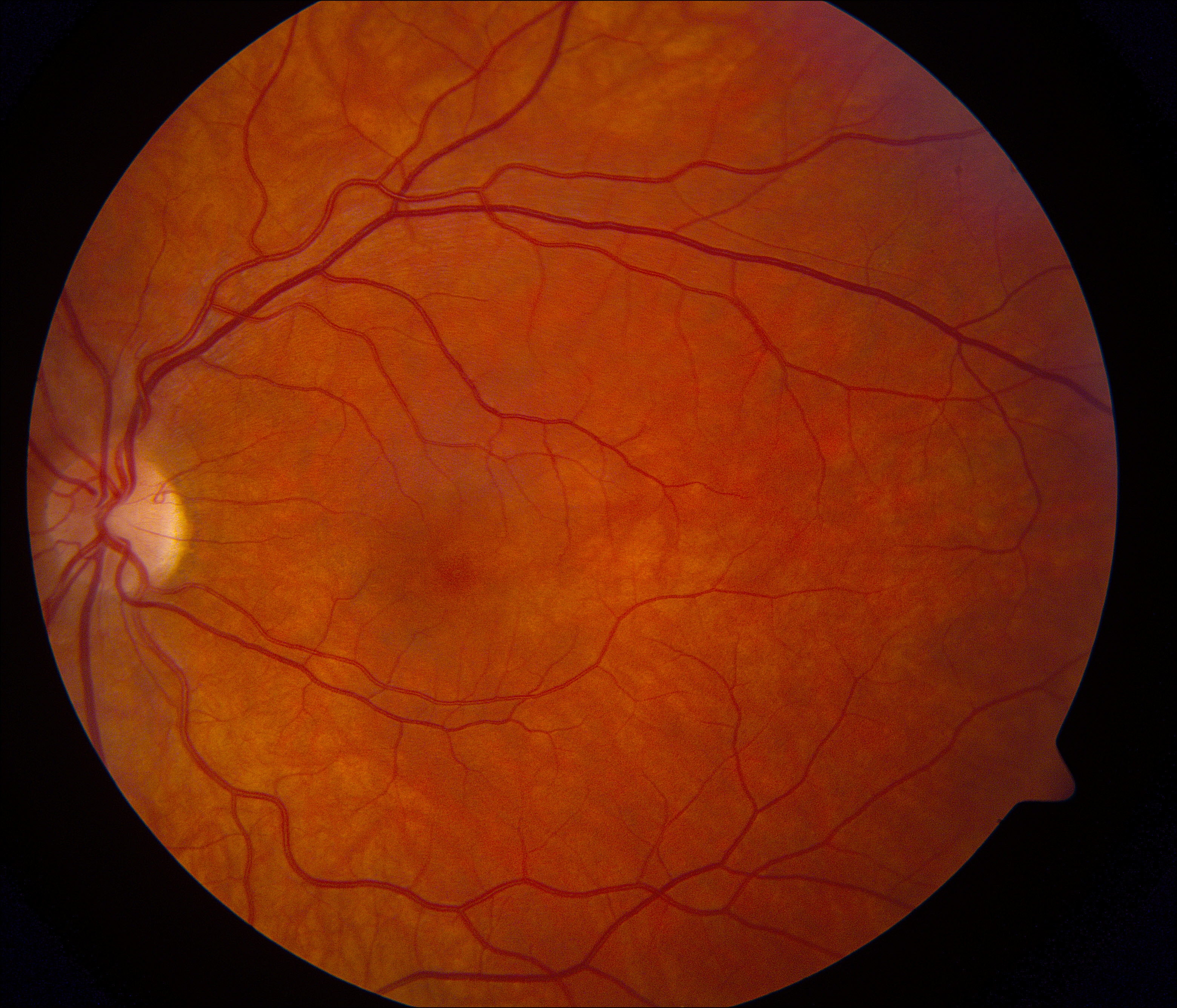 Color fundus photograph of the left eye in a healthy patient